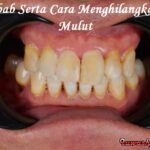 12 Penyebab Serta Cara Menghilangkan Bau Mulut Secara Permanen